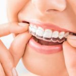 Cosmetic orthodontics Panorama City CA teeth whitening