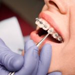 The Benefits of Early Orthodontic Care for Children